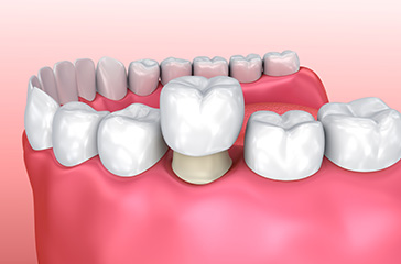 Pacific Family Dentistry | Dentures, Oral Cancer Screening and Implant Dentistry