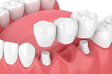 Pacific Family Dentistry | Implant Dentistry, Periodontal Treatment and SureSmile reg Aligners